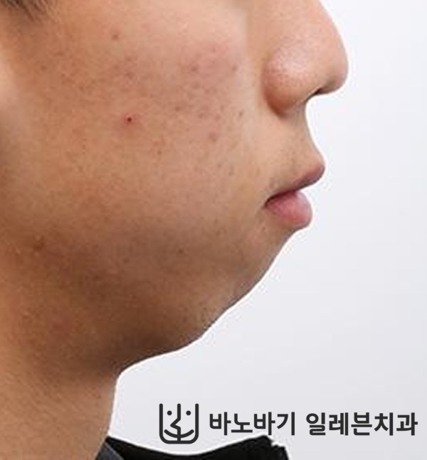 턱끝수술 환자 교정 전 옆모습
