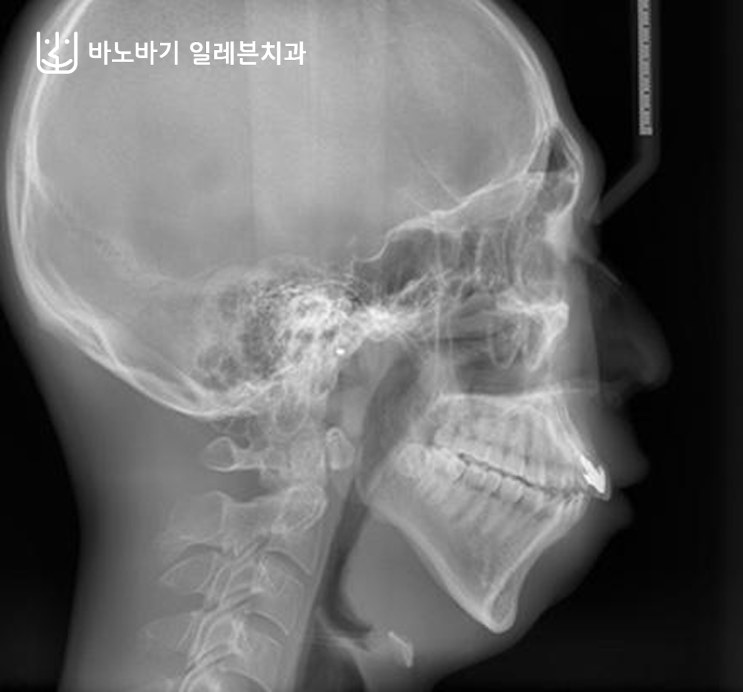 턱끝수술 전 측면 두부방사선 사진