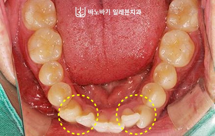 교정 전 하악 교합면, 겹쳐 있는 하악 앞니