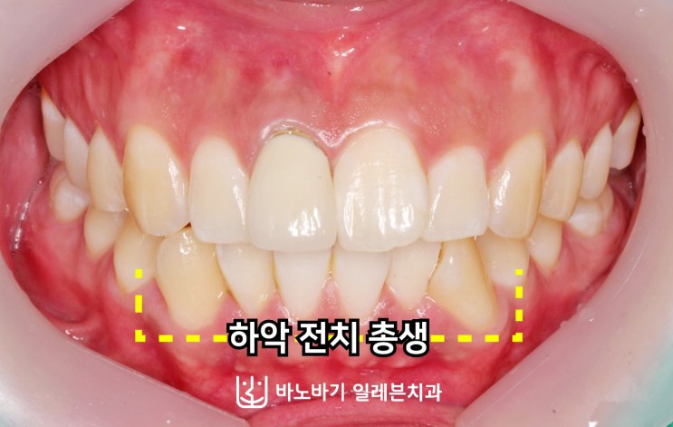 교정 전 정면 교합, 하악 전치부 총생