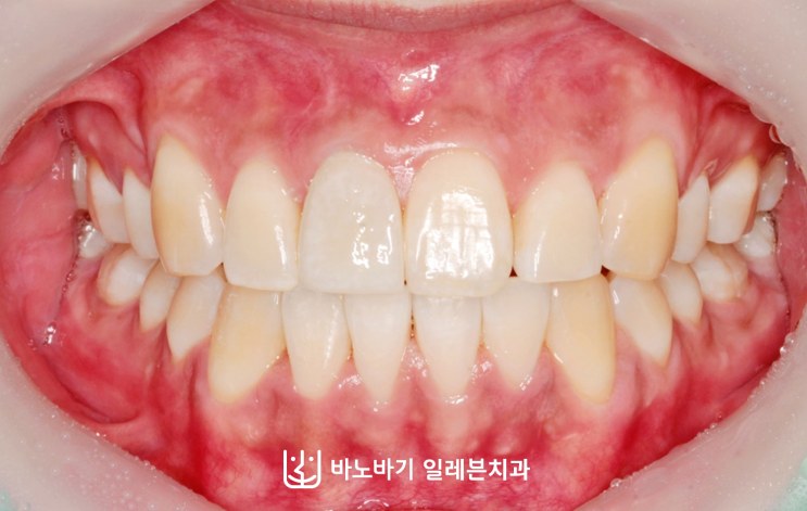 수술 전 교정 후 정면 교합, 가지런해진 하악 앞니
