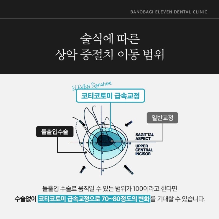 술식에 따른 상악 중절치 이동 범위, 일반교정과 코티코토미 급속교정 비교