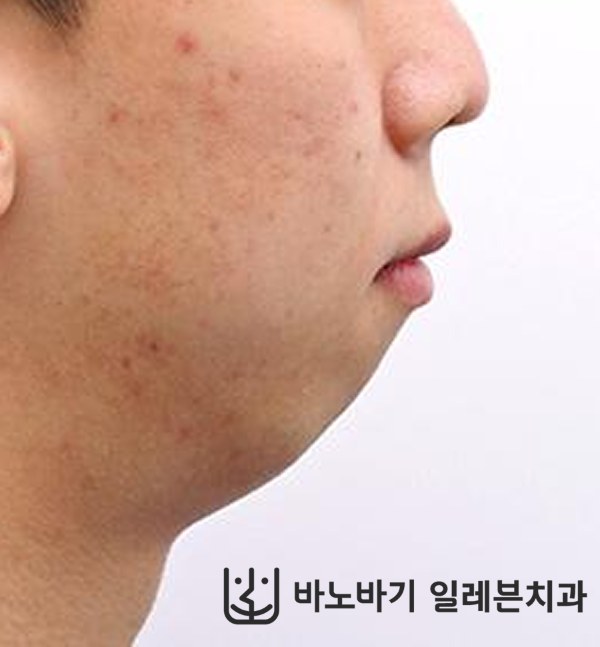 턱끝수술 환자 교정 후 옆모습