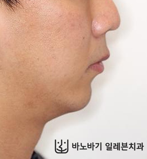 턱끝수술 후 옆모습
