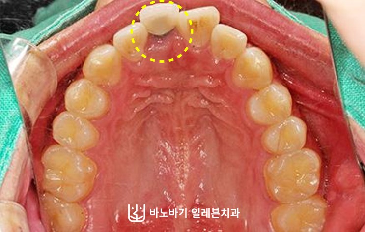 교정 전 상악 교합면