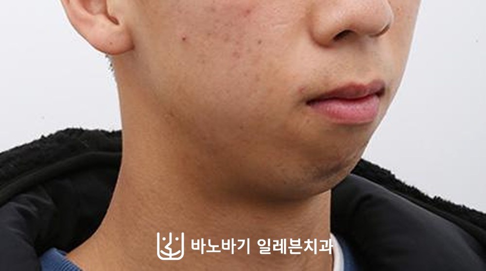 턱끝수술 전 비스듬한 각도의 얼굴, 경계가 모호한 목과 턱선