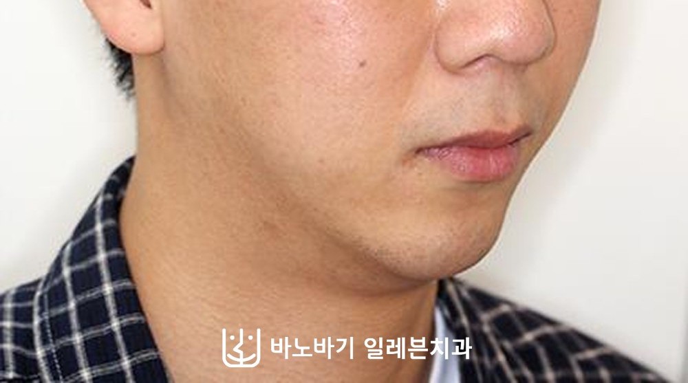 턱끝수술 후 비스듬한 각도의 얼굴, 볼륨감이 생긴 아래턱