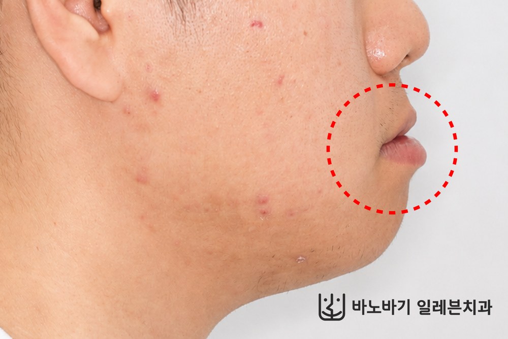 아랫입술이 앞으로 도드라진 주걱턱 환자의 치료 전 측면 사진