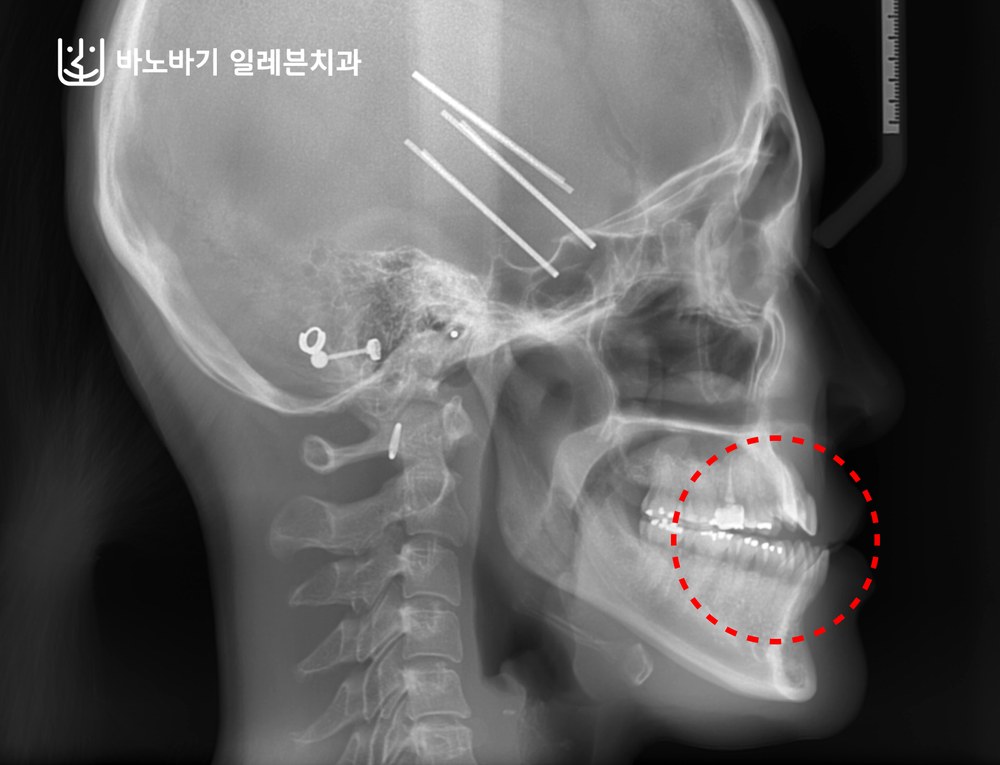 앞니가 닿지 않는 개방교합이 동반된 주걱턱 환자의 치료 전 측면 엑스레이