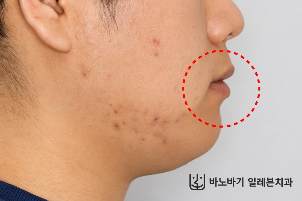 비수술 교정 후 아랫입술 돌출이 개선된 측면 사진