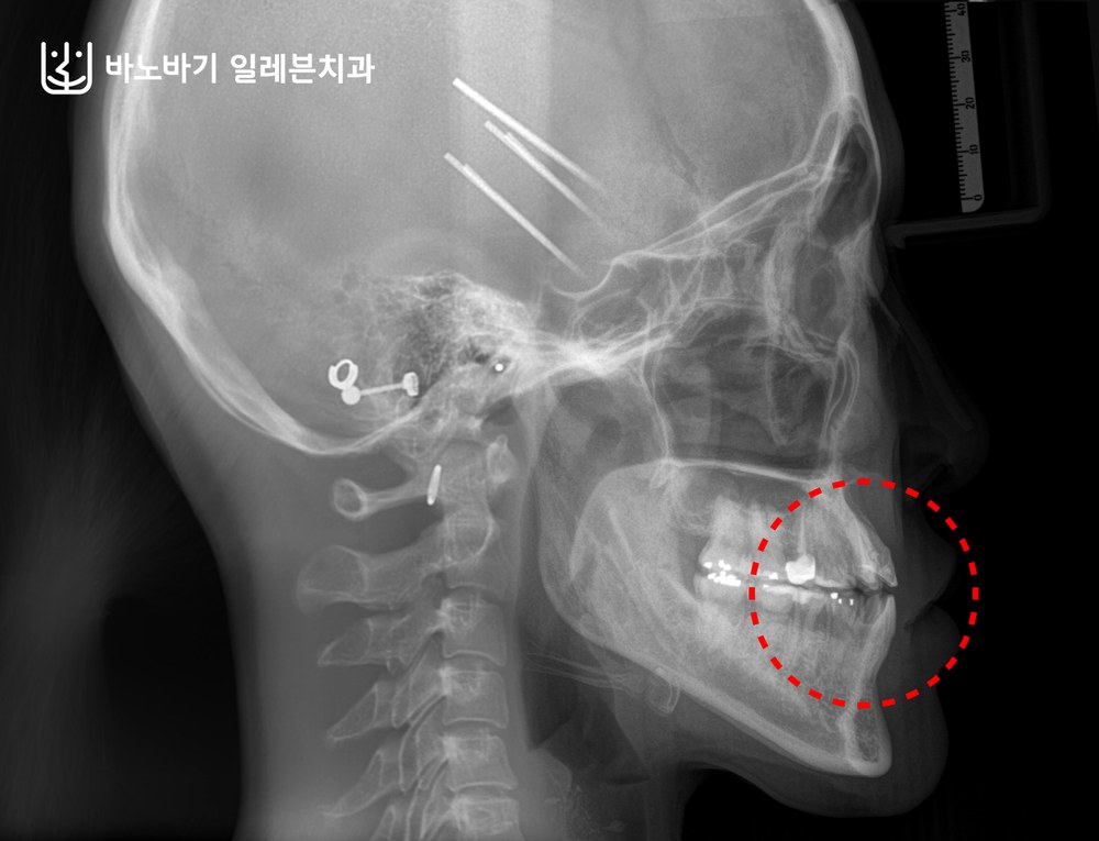 교정 후 개방교합이 개선된 측면 엑스레이