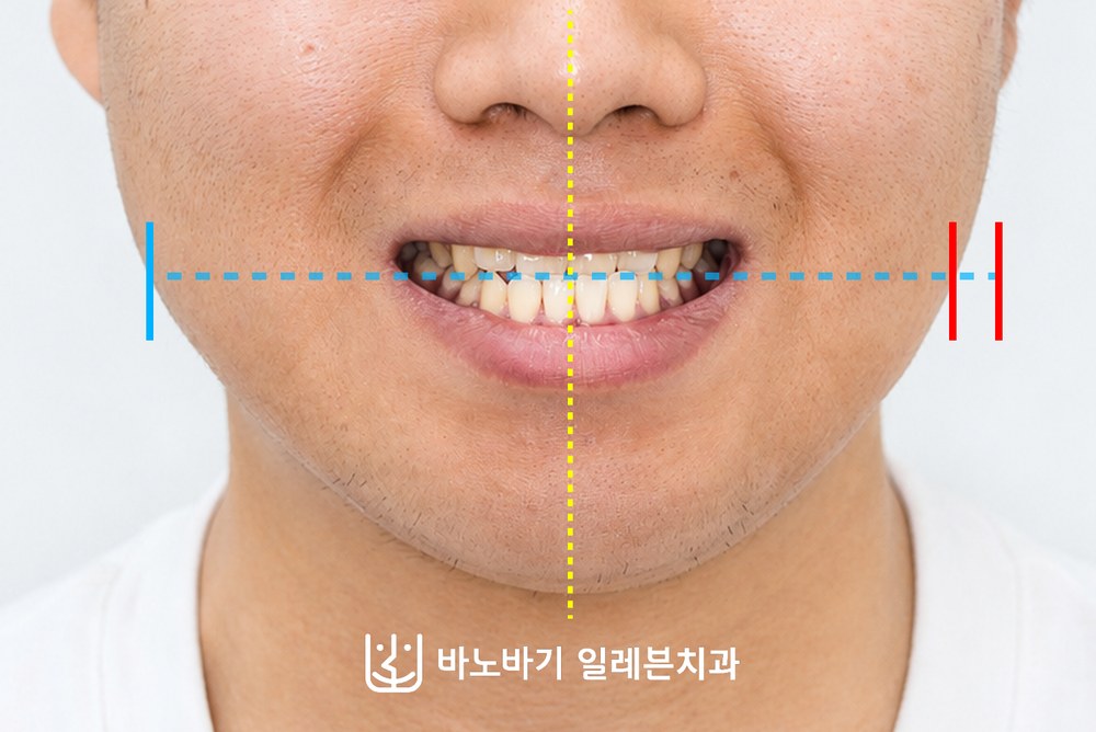 웃을 때 교합평면이 한쪽으로 기울어 보이는 주걱턱 환자의 치료 전 정면 사진