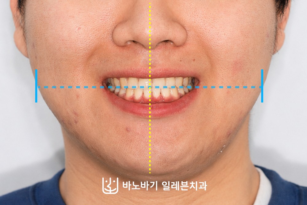 교정 후 교합평면의 기울기가 개선된 정면 사진