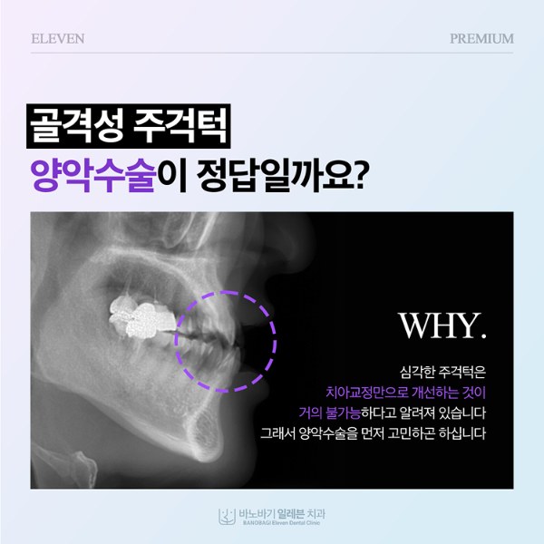 골격성 주걱턱에서 양악수술이 정답인지 묻는 일레븐치과 안내 이미지
