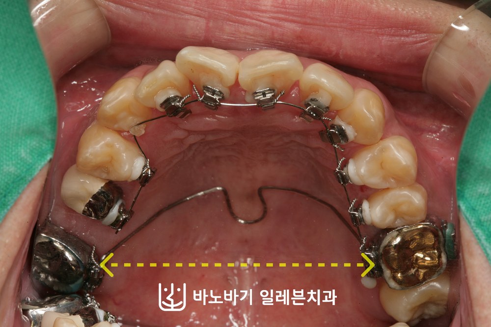 상악 악궁확장장치와 설측교정 장치