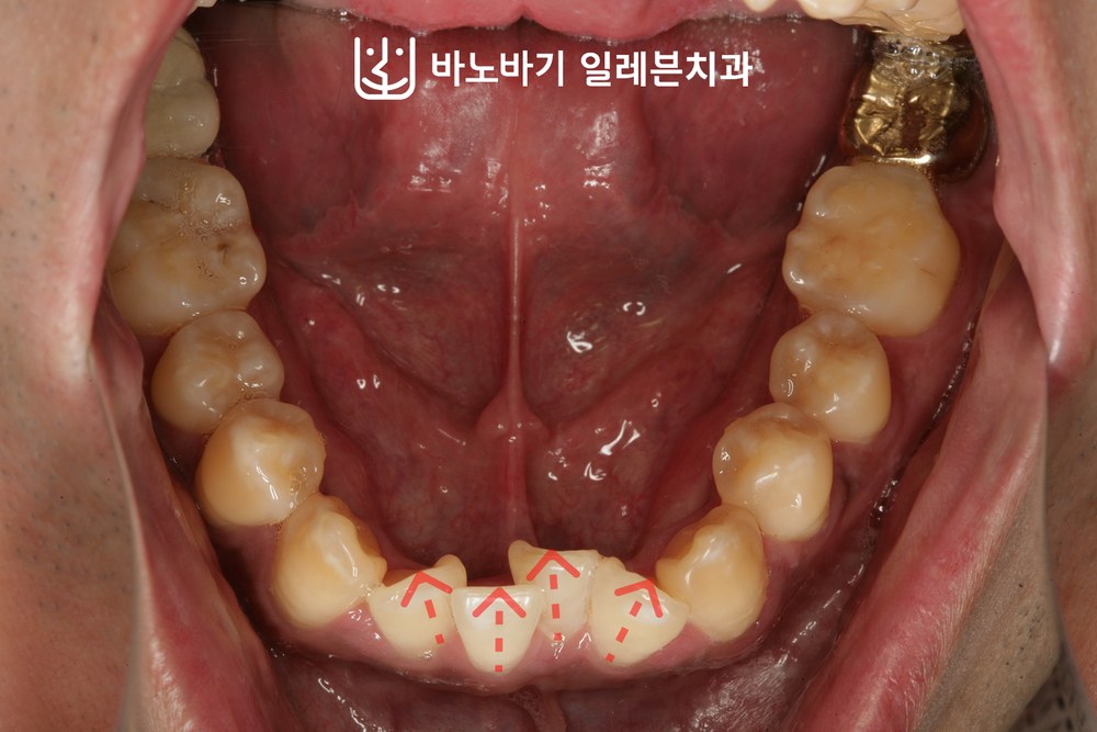 교정 전 하악 교합면, 설측으로 경사된 하악 전치