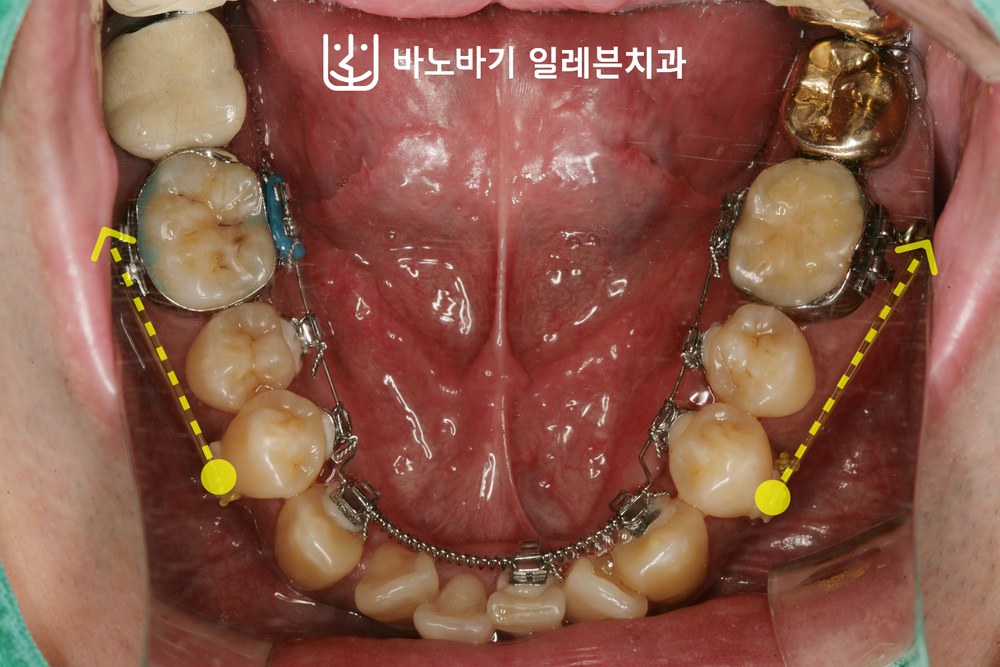 치료 중 하악 교합면, 설측교정 장치와 하악 구치부 후방이동