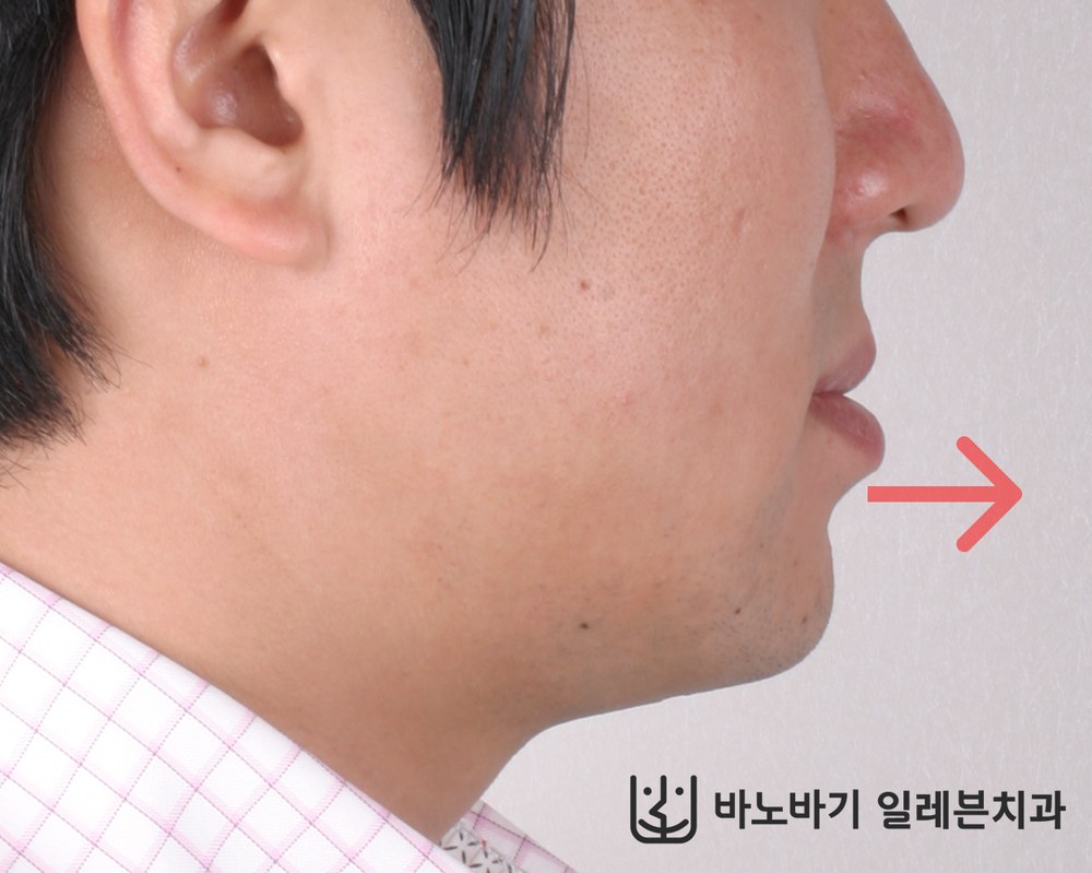 교정 전 옆모습, 앞으로 나온 아랫입술