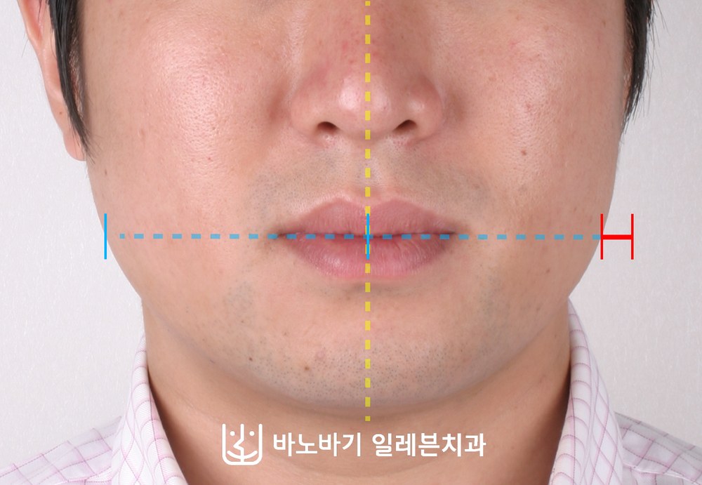 얼굴 비대칭 치아교정 전 정면, 한쪽으로 치우쳐 보이는 하안면