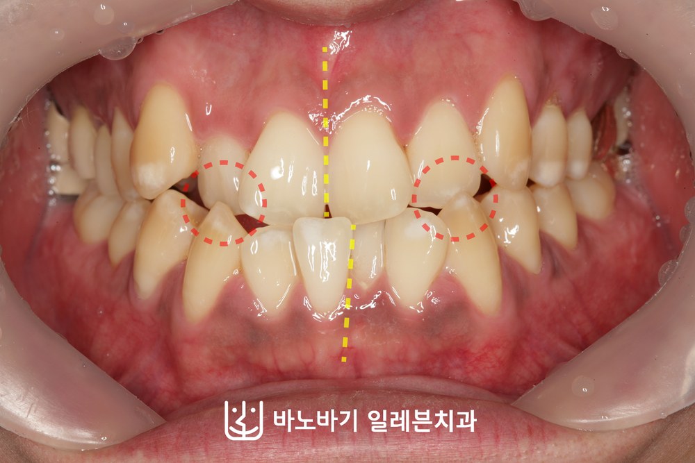 교정 전 정면 교합, 측절치 부위 반대교합과 덧니, 어긋난 중심선