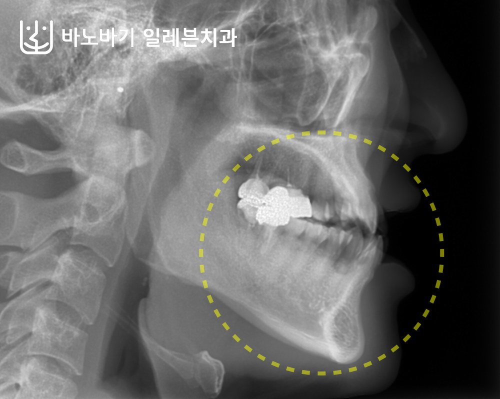 교정 전 측면 두부방사선 사진, 3급 부정교합