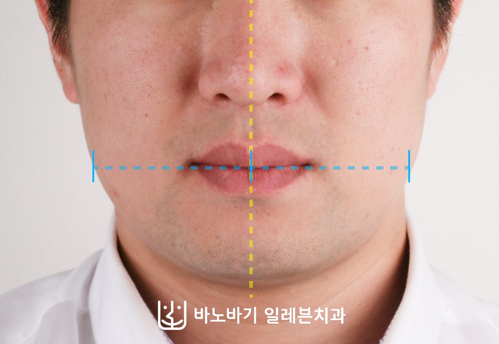얼굴 비대칭 치아교정 후 정면, 좌우 균형이 맞춰진 하안면
