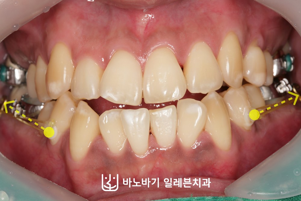 치료 중 정면, 사이드 플레이트를 이용한 하악 치열 후방이동