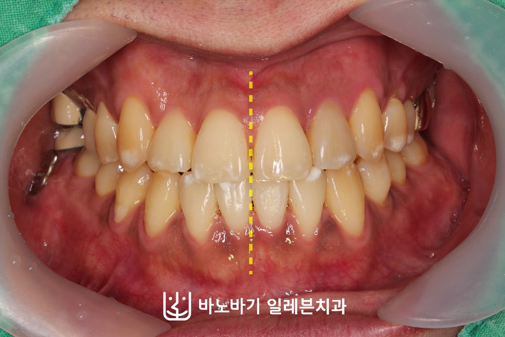 교정 후 정면 교합, 일치된 중심선과 고르게 배열된 치열