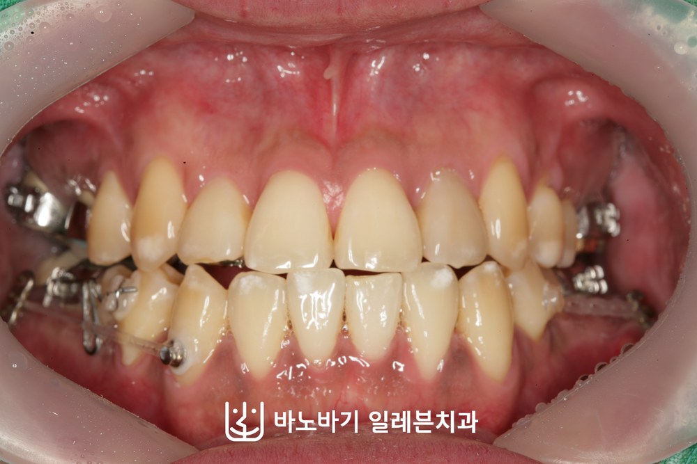 치료 후반 정면 교합, 고르게 배열된 앞니