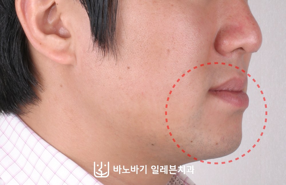 얼굴 비대칭 치아교정 전 옆모습