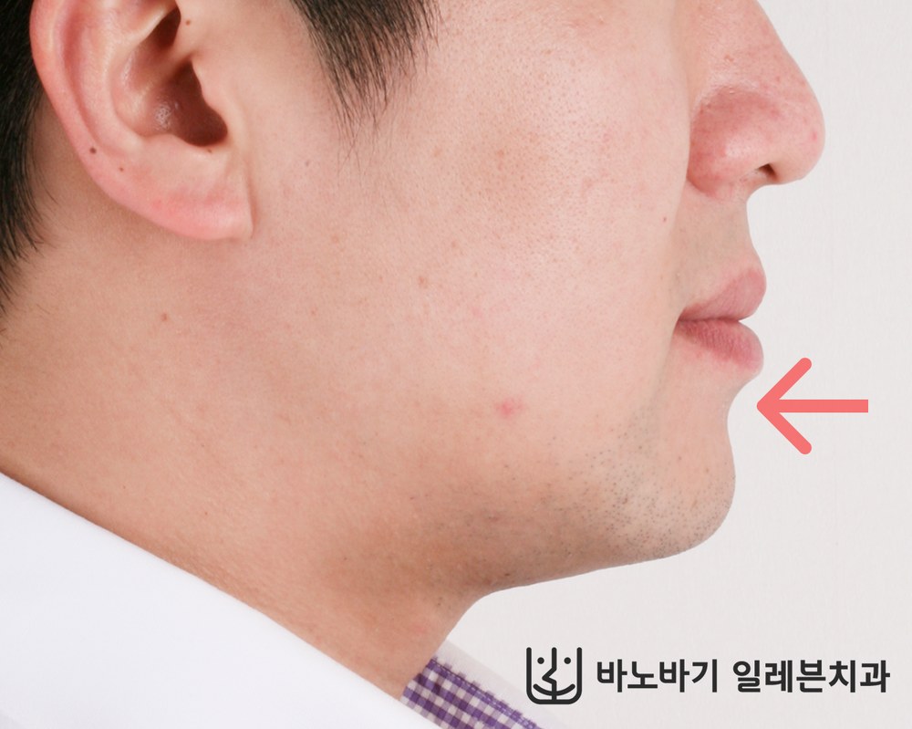 교정 후 옆모습, 뒤쪽으로 들어간 아랫입술