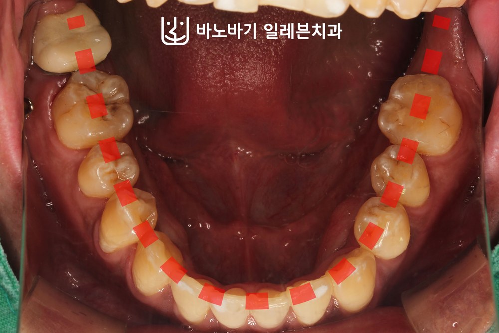 교정 후 하악 교합면, U자형 아치로 정리된 악궁