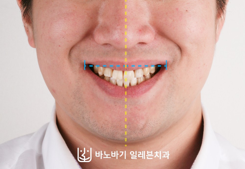 치아교정 후 정면 미소