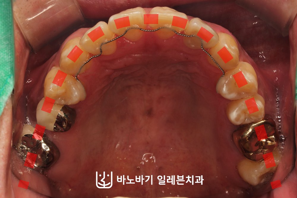 교정 후 상악 교합면