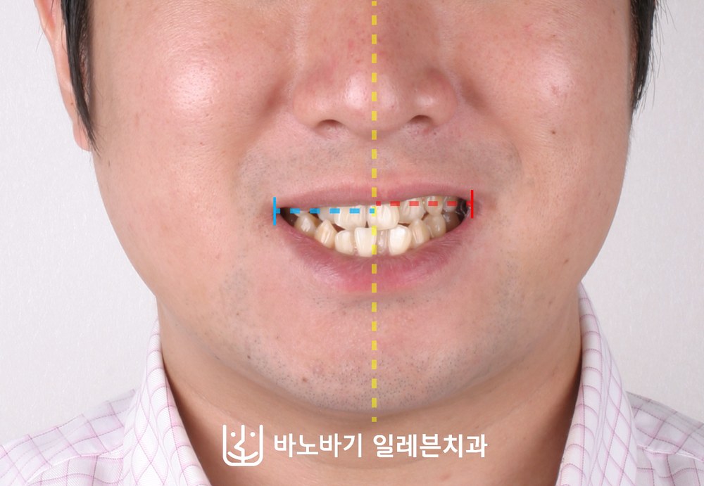 치아교정 전 정면 미소