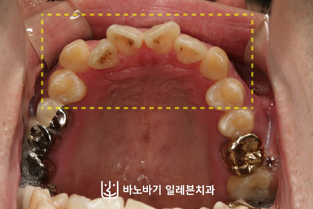 교정 전 상악 교합면