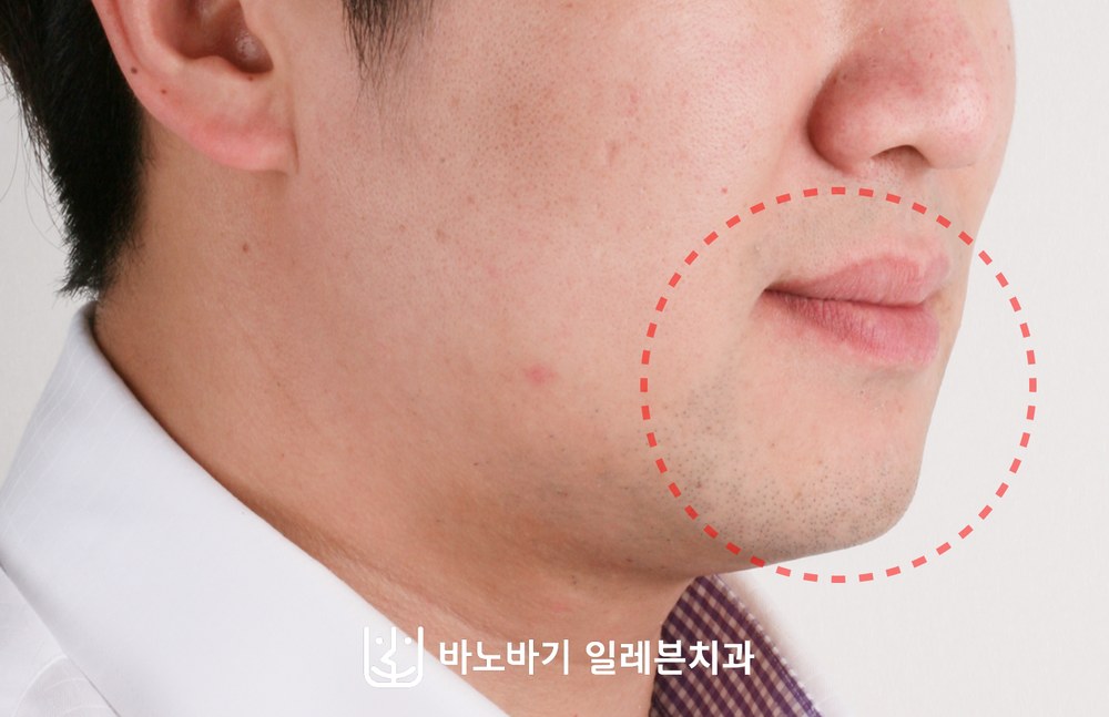 얼굴 비대칭 치아교정 후 옆모습