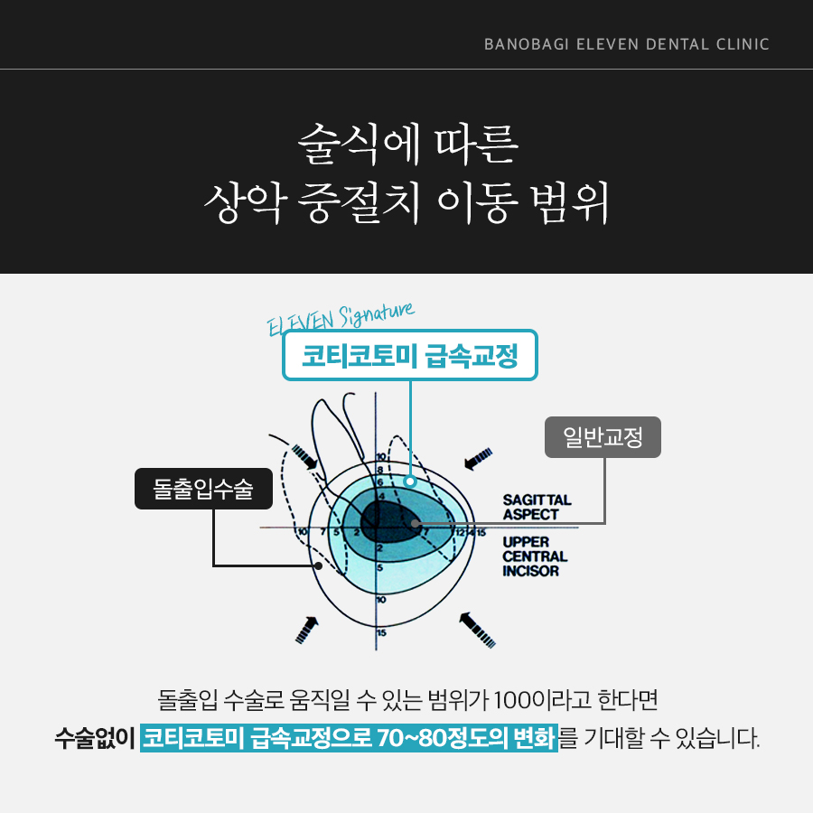 술식에 따른 상악 중절치 이동 범위, 일반교정과 코티코토미 급속교정 비교