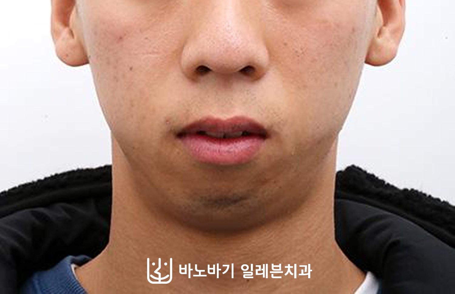 턱끝수술 병행 환자의 교정 전 정면