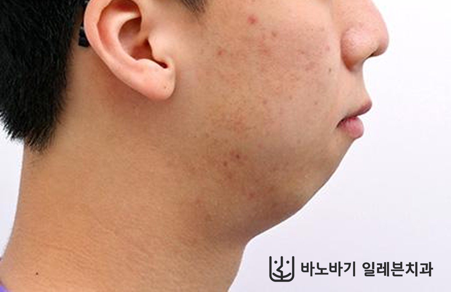 턱끝수술 병행 환자의 교정 후 옆모습