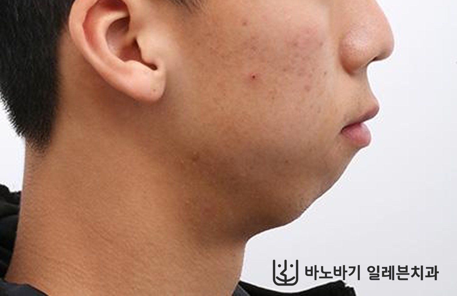 턱끝수술 병행 환자의 교정 전 옆모습
