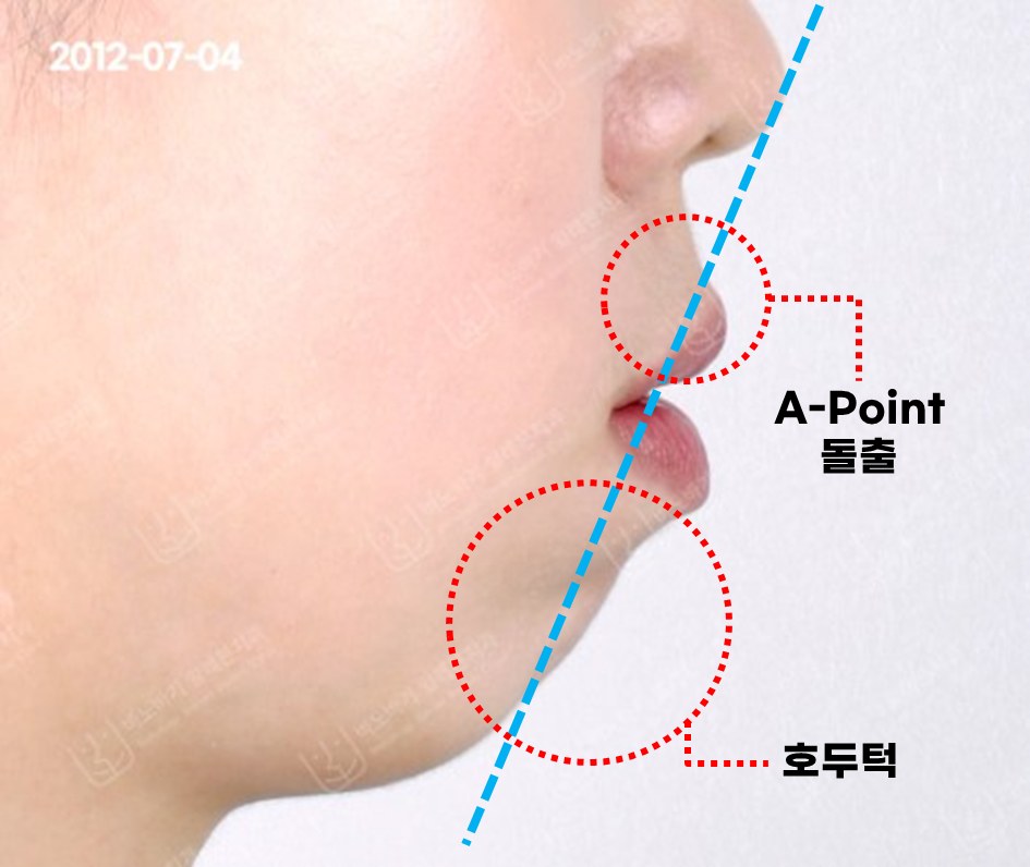 무턱 교정 전 옆모습, A-Point 돌출과 호두턱