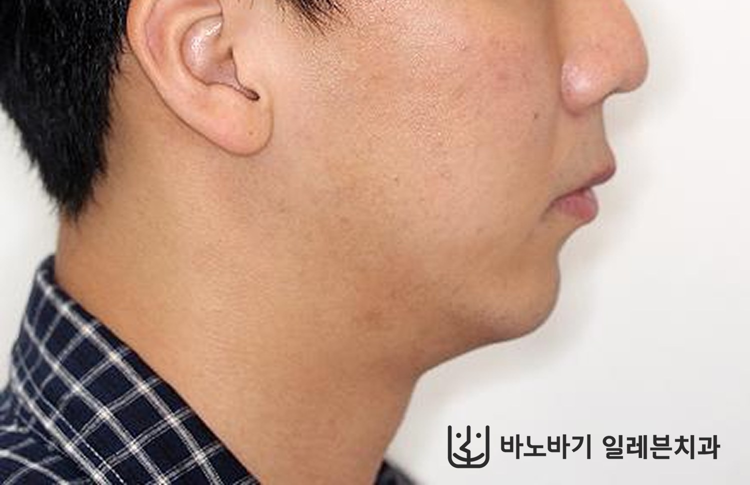 턱끝수술 후 옆모습