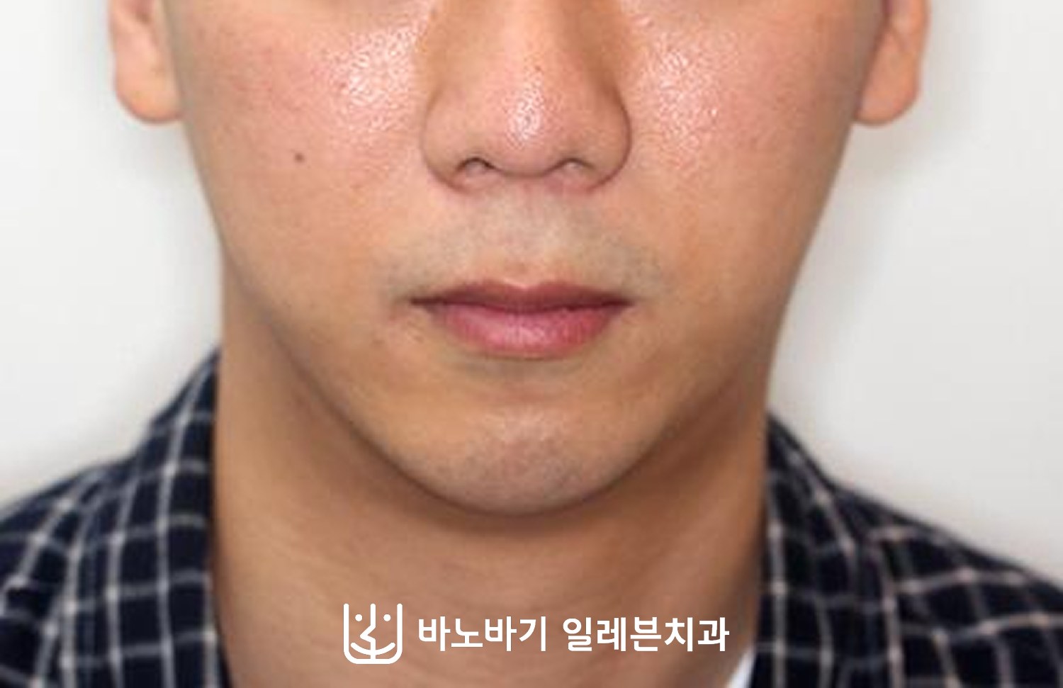 턱끝수술 후 정면