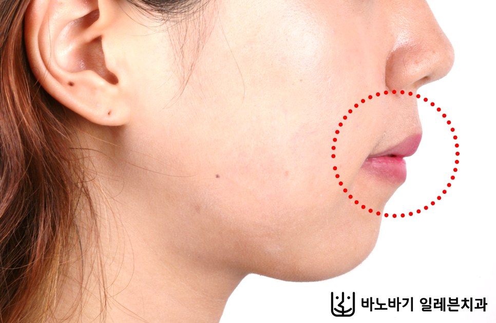 상악 2개 발치교정 후 옆모습