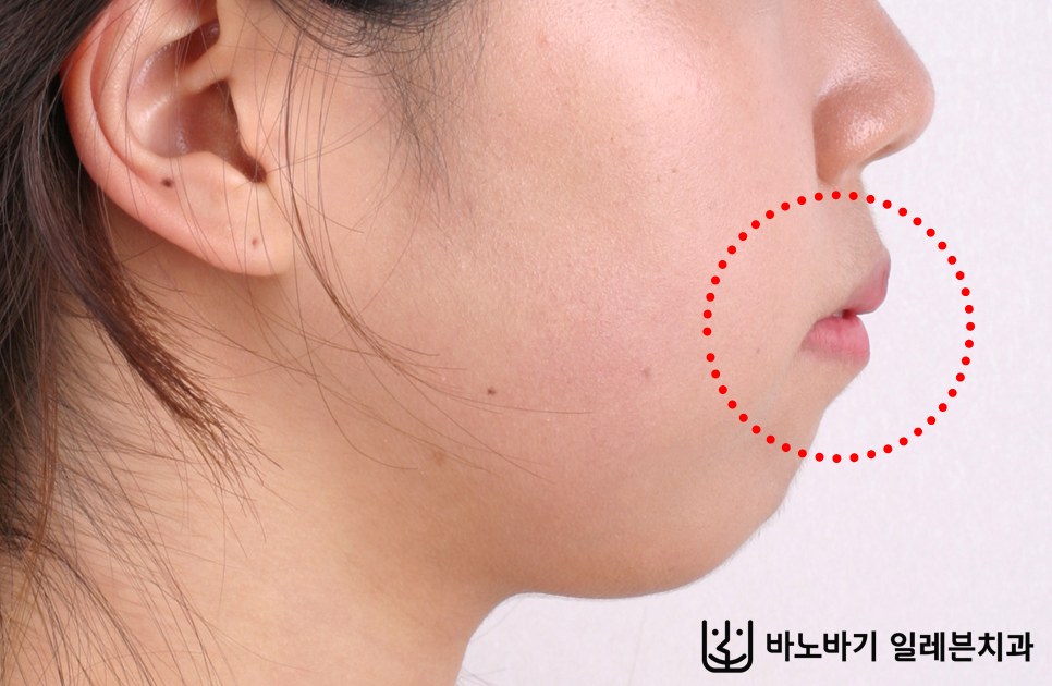 상악 2개 발치교정 전 옆모습
