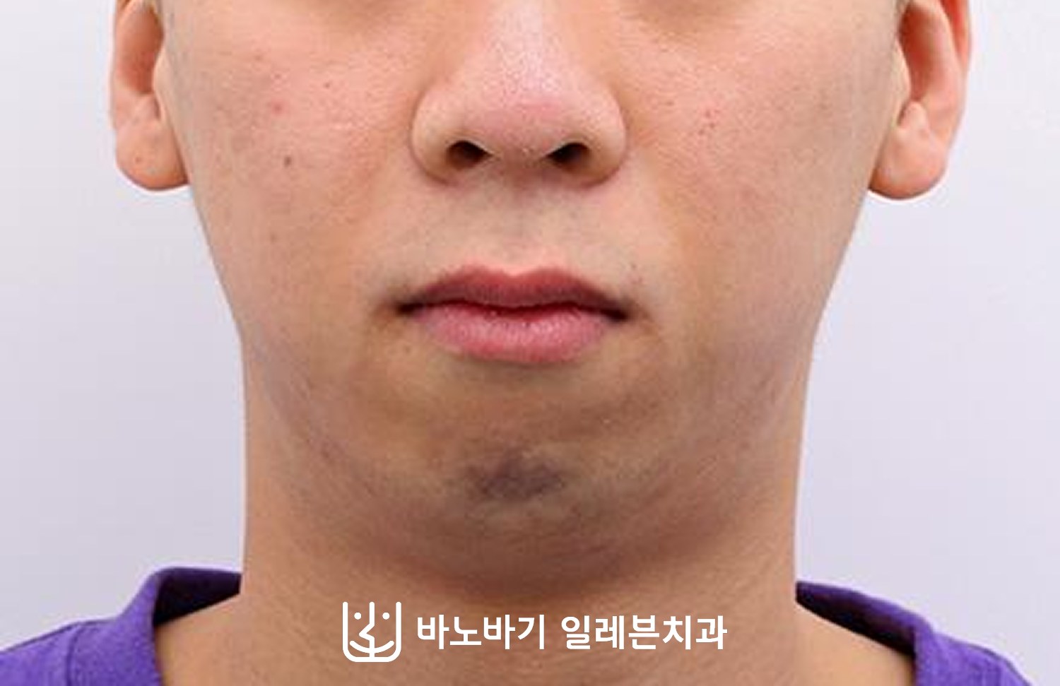 턱끝수술 병행 환자의 교정 후 정면
