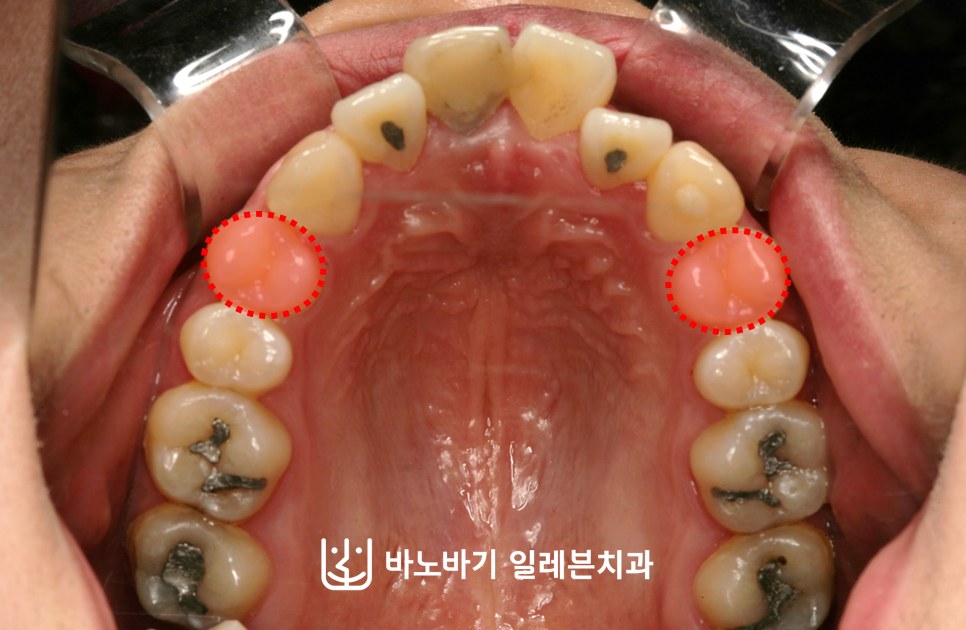 발치 부위를 표시한 교정 전 상악 교합면