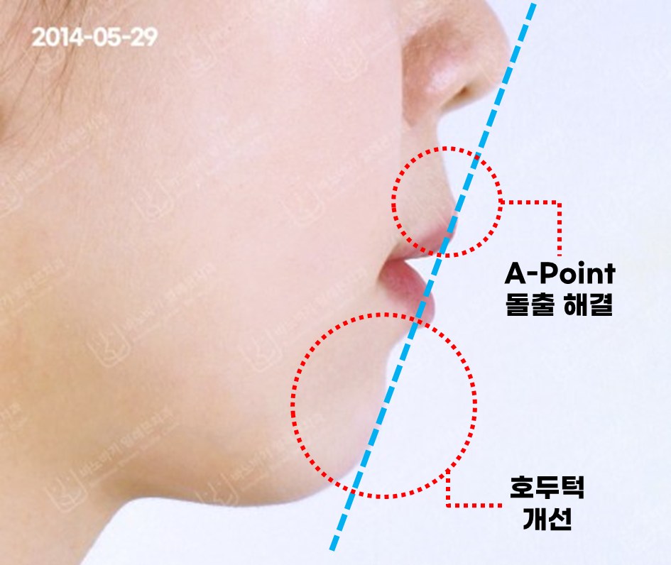 소구치 4개 발치 교정 후 옆모습, A-Point 돌출 해결과 호두턱 개선