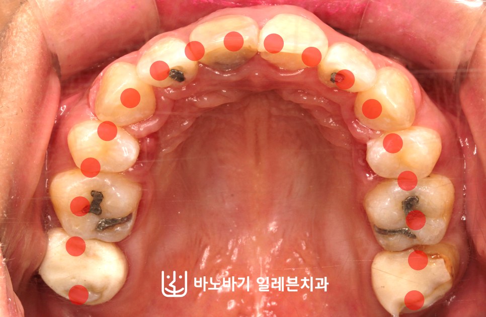 상악 2개 발치교정 후 상악 교합면